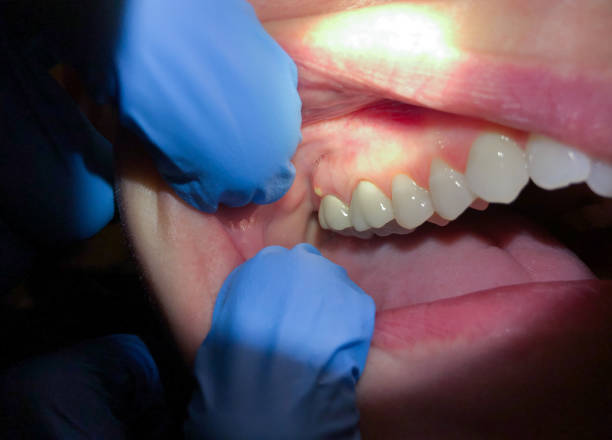 Best Knocked-Out Tooth (Avulsed Tooth) Treatment in Lexington, OH