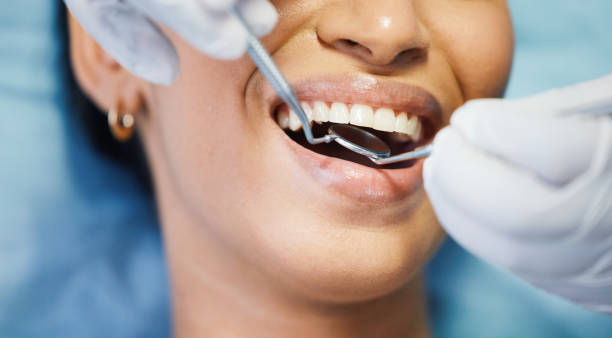 Best Emergency Wisdom Tooth Extraction in Lexington, OH